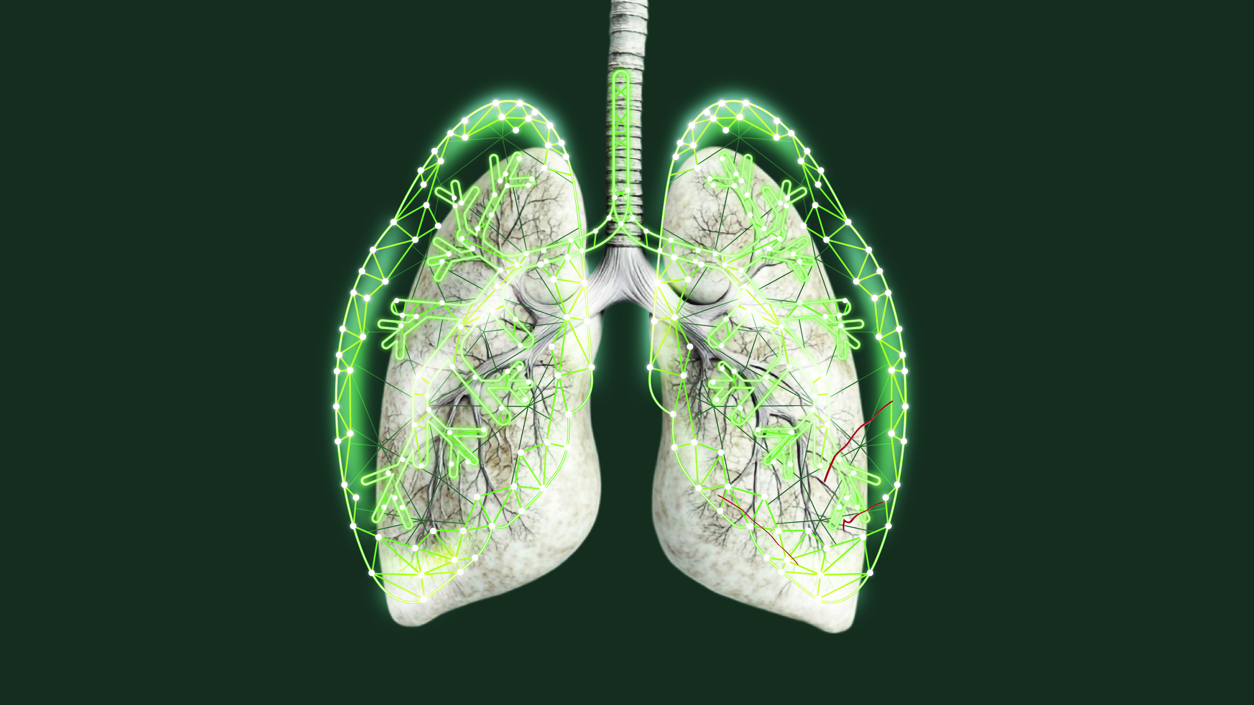  Tüberkülozun Dünü, Bugünü