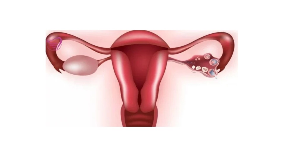 Endometriozisi Konuşuyoruz